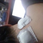 <b>뒷목</b> 종괴 수술!