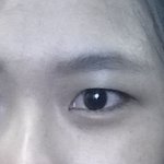 쌍수할까요?