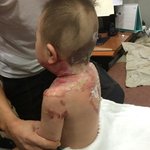 [도와주세요] 어린이집에서 3도화상을 입은 16개월 아기, 도와주세요