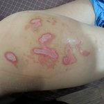 [도와주세요] 어린이집<b>화상</b>사고 사진주의