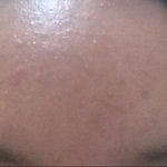 [댓글부탁해] 내 <b>좁쌀</b>여드름 어떡함'(약혐