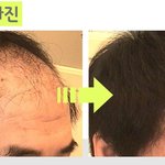 [댓글부탁해] <b>탈모</b>예방 다들 어떻게 하시나요?