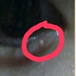 [댓글부탁해] 약간좀혐)) <b>눈밑</b>에 뭐가 났는데 도와줘ㅠ