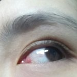 눈충혈 해결방법없나요ㅠㅠ