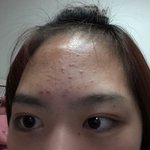 [exo] 혐짤인데 <b>이마</b>여드름 없애는법알아?