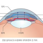 [댓글부탁요] 고도근시자 15분 투자의 아쿠아 icl 렌즈삽입술로...