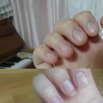 !!!!!!!!드디어  <b>손톱</b> 물어뜯는 버릇 고쳤어요 !!