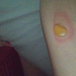 [댓글부탁해] 장판에데여서 <b>물집</b>이잡힌걸 (사진있어요)