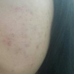 [꼭조언부탁] 내피부노답;;(사진잇음)