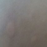 후기) <b>대상</b><b>포진</b>인가요??ㅠㅠ 도와주세요??ㅇ