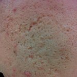 [사진유]이 피부를 어떻게 하면 좋을까요..[극혐,<b>눈갱</b> 주의]+추가