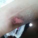 [도와주세요] (수정)고데기가 터져서 팔에 화상을 입었습니다.....