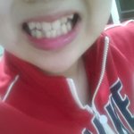 [댓글부탁해] 나처럼 <b>덧니</b> 심한 친구 있어?