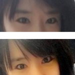 수술 <b>전후</b> 달라진거같나요?ㅠㅠ