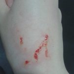 남친이 활켰는데 <b>흉터</b>될까?ㅜ