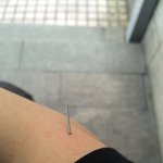 [사고] 한의원 침 의료사고