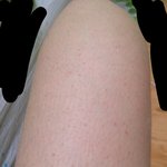 [꼭조언부탁] 혐) 다리에 <b>닭살</b> 심하신 분들 ...