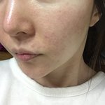 [꼭조언부탁] 피부 관리 시작했는데 이정도면 성공일까요? [사진有]