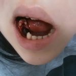 [꼭댓글부탁] 스<b>켈링</b> 후 피가 안멈춰요