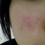 ㅁㅊ티트리 <b>오일</b> 부작용남