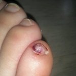 [EXO] <b>발톱</b>이거어떻게