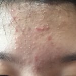 [댓글부탁해] 여드름 많이심각해?? ( <b>극혐</b>주의)
