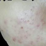 나 진짜 <b>간절</b>한데 이 피부 어떻게 해야 해