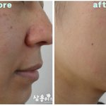 기미치료! 장희빈미안법으로 깔끔하게 없애기!!