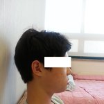 [양악수술] 사진 o) 양악수술 후기