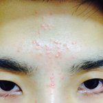 필러후 염증?<b>모낭염</b>?여드름?부작용?