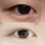 쌍수 고민