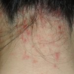 <b>지긋</b>한 여드름,지루성피부염ㅡㅡ 지친다