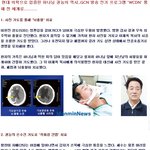 "소세포 폐암, 마비성 사시를 치료받고 건강해졌어요"