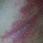 청피<b>해독</b>환 아시나요?지루성피부염에 좋다던데..