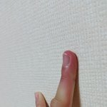 [댓글부탁해] 손가락에 모기물렸는데 <b>극혐수준</b>;;;;