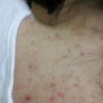 [꼭댓글부탁] (혐사진유)등<b>드름</b>없애는법좀 제발 도와줘.. 너무심각해