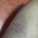 전에 사진과 함께 맞은 사진을 올렸습니다