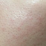[댓글부탁해] 혐) 나 <b>모공</b>이 너무 넓어... 엄청 스트레스야