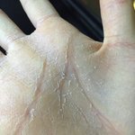 사진 혐?) 손바닥 피부가 다 벗겨졌어요 ㅠㅠ 
