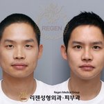 성형<b>전후</b>