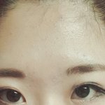 [댓글부탁해] <b>쌍수</b>이렇게되면망한건가요?사진있어요