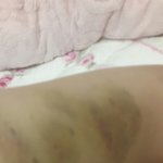 친구한테 맞아서 이케됨ㅋㅋㅋㅋㅋㅋㅋㅋㅋ..
