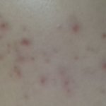 [댓글부탁해] 여드름 <b>흉터</b>ㅠㅠ 댓 부탁해요 ㅠ