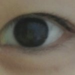 [댓글부탁해] 수술하면 눈웃음이 달라져???