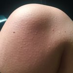 혐오주의 ㅠㅠ <b>모공</b>각화증좀 봐주세요