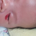 [꼭봐주세요] 신생아 얼굴에 상처가 있어요 (사진있음)
