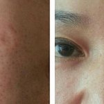 6개월 후기 많이 좋아지지 않았나요? (<b>미백</b>,블랙헤드,모공,리프팅)