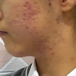 [댓글부탁해] 혐주의)여드름<b>흉터</b> 어떻게없애?ㅠㅠ
