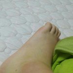 <b>발목</b>다쳤는데 병원가봐야되겠지..