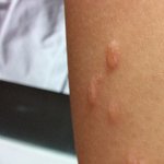 [ㅠㅠㅠㅠㅠ] 다리에 <b>물집</b>이 막 잡혔어(혐주의)